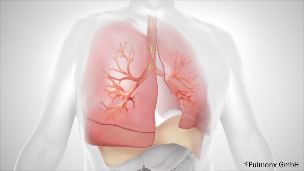 Leichter Atmen bei schwerer COPD und Lungenemphysem: Zephyr ...
