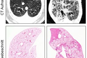 Schlüsselprozesse bei der Entstehung von Lungenfibrose identifiziert