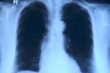 Tuberkulose in Zeiten von SARS-CoV-2 und COVID-19; was Betroffene und ehemalige Patienten wissen müssen