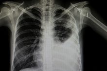 Ist es Corona oder nicht: Studentin entwickelt Röntgen-Software für COVID-19-Diagnose