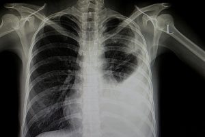 Ist es Corona oder nicht: Studentin entwickelt Röntgen-Software für COVID-19-Diagnose