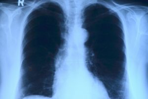 Tuberkulose in Zeiten von SARS-CoV-2 und COVID-19; was Betroffene und ehemalige Patienten wissen müssen