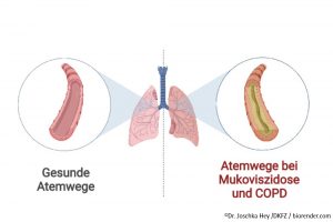 Mukoviszidose & COPD: Zäher Schleim programmiert Immunzellen um und fördert Entzündungen der Atemwege