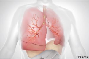 Leichter Atmen bei schwerer COPD und Lungenemphysem: Zephyr® Lungenventil ist jetzt neu im Disease Management Programm (DMP) der Krankenkassen verfügbar