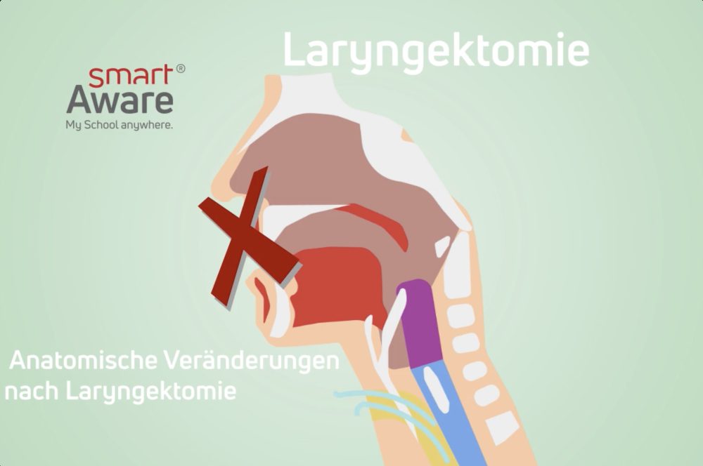 Jetzt online schulen: Laryngektomie