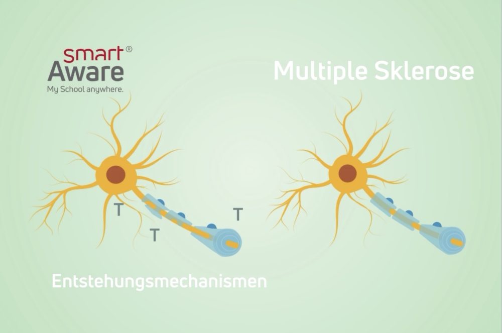 Jetzt online schulen: Multiple Sklerose