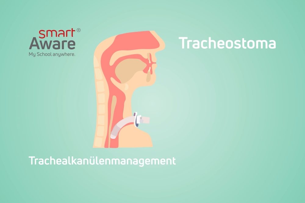 Jetzt online schulen: Durchführung eines Trachealkanülenwechsels