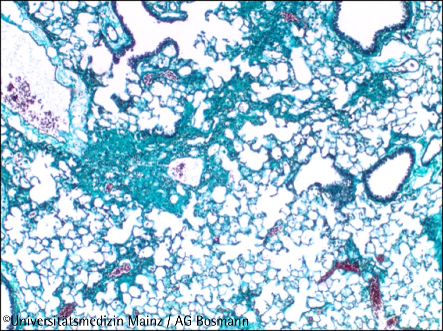 Mainzer Wissenschaftler:innen entdecken bisher unbekannte Ursache für die Entstehung der Lungenfibrose