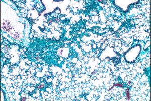 Mainzer Wissenschaftler:innen entdecken bisher unbekannte Ursache für die Entstehung der Lungenfibrose