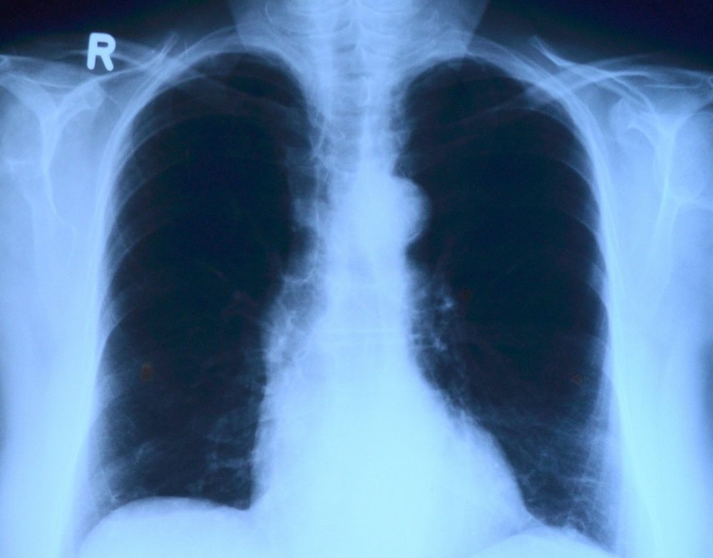 Tuberkulose in Zeiten von SARS-CoV-2 und COVID-19; was Betroffene und ehemalige Patienten wissen müssen