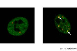 Nervenkrankheit ALS: Zellulärer Pannendienst könnte Proteinverklumpung vermeiden