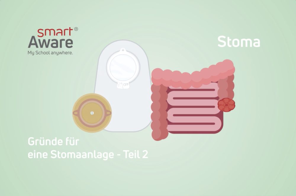 Jetzt online schulen: Versorgung von Ileostoma und Kolostoma