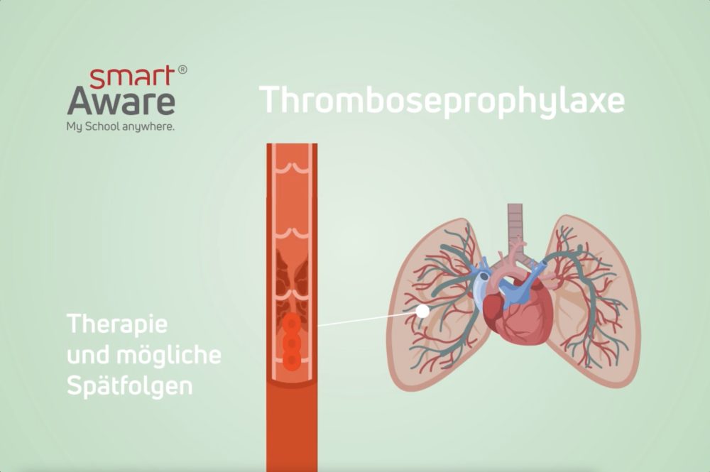 Jetzt online schulen: Thrombose und prophylaktische Maßnahmen