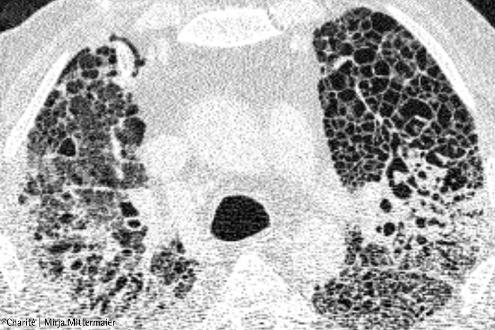 COVID-19-Lungenversagen: Warum Betroffene so lange beatmet werden müssen