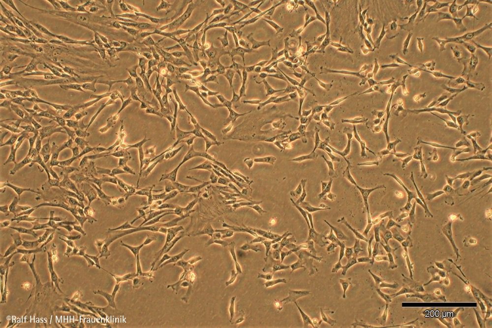 Dank Nabelschnur-Stammzellen: Erstmals Therapieerfolg bei schwerem Lungenhochdruck