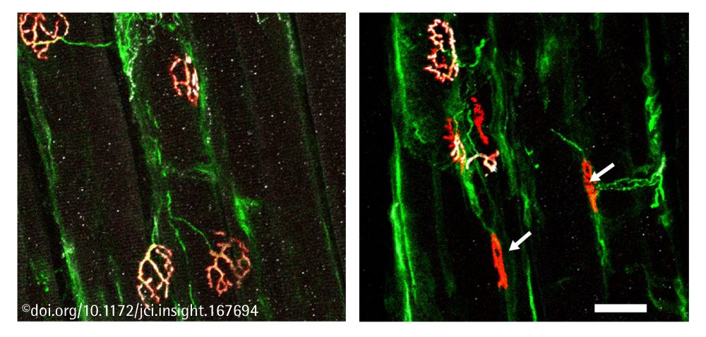 ALS-Studie zur Rolle der neuronalen Erregbarkeit für den Krankheitsverlauf – Genregulator SRF schützt Motoneuronen
