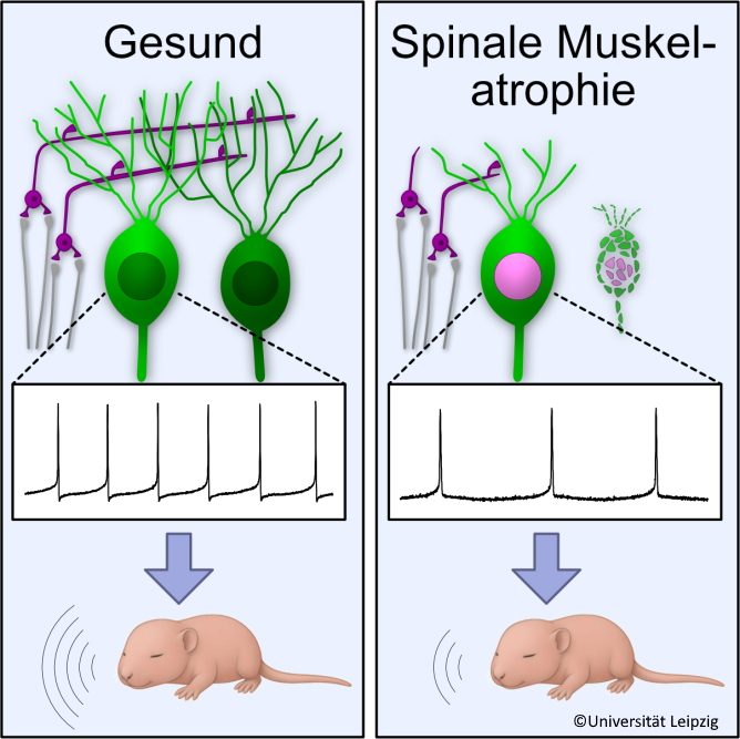 Neue Erkenntnisse zur Rolle des Kleinhirns bei spinaler Muskelatrophie