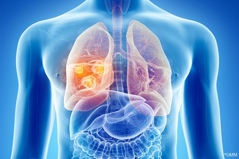 Wer profitiert von einer zielgerichteten Therapie beim nicht-kleinzelligen Lungenkarzinom?