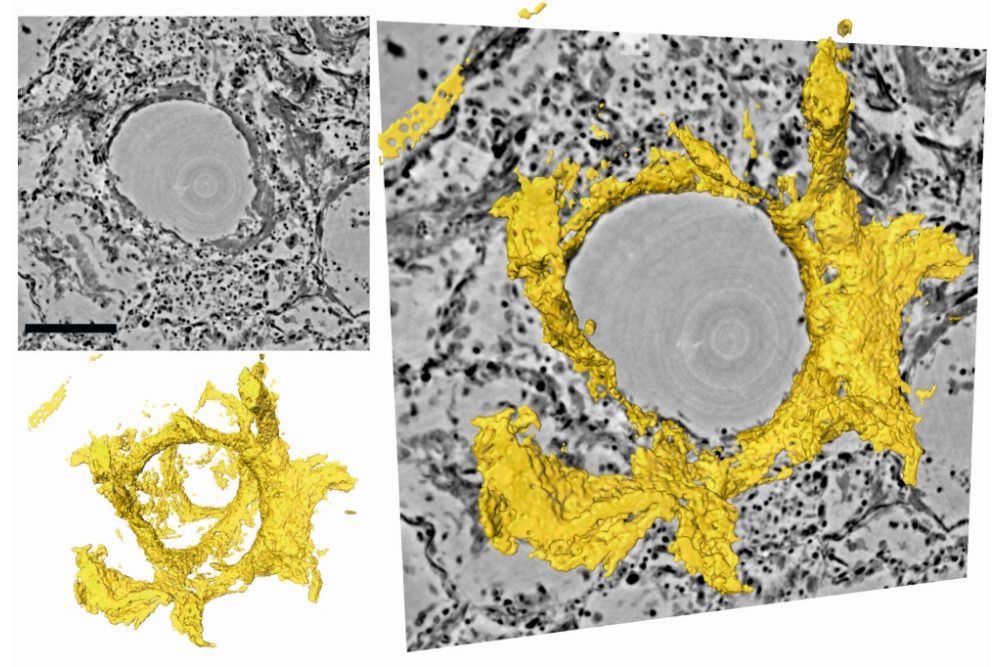 Neue Einsichten in Lungengewebe bei Covid-19-Erkrankungen: Team unter Göttinger Leitung entwickelt neue Bildgebung