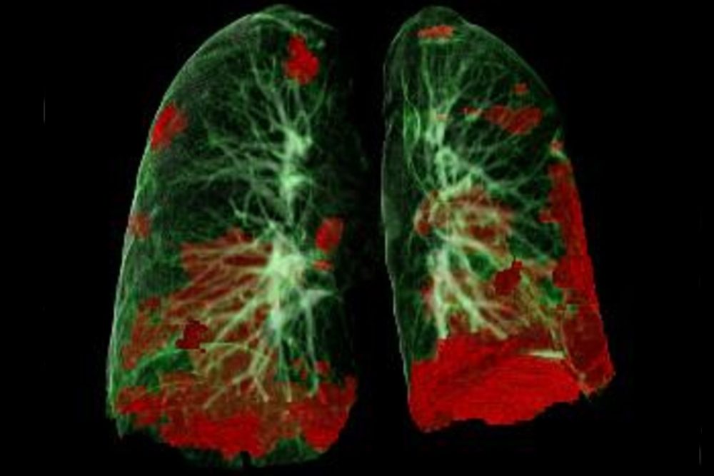 COVID-19 Langzeitstudie: Schwer Erkrankte profitieren von langfristiger und interdisziplinärer Nachsorge