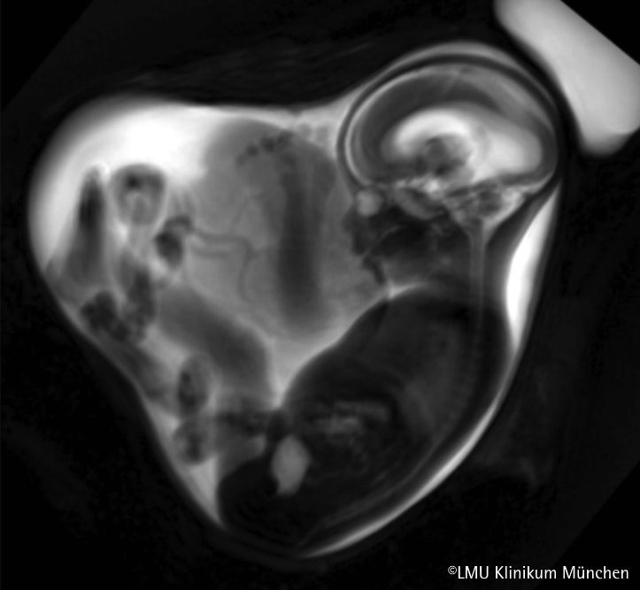 SARS-CoV-2 beeinträchtigt Lungenentwicklung von Feten