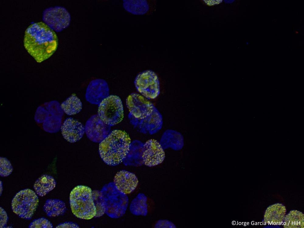Amyotrophe Lateralsklerose: Was Rotwein mit einer künftigen Therapie zu tun haben könnte
