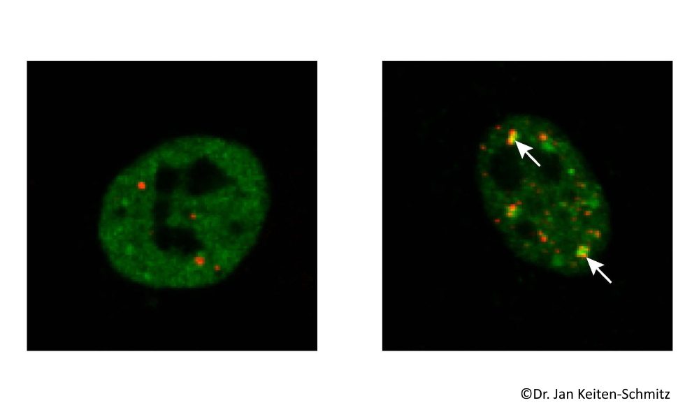 Nervenkrankheit ALS: Zellulärer Pannendienst könnte Proteinverklumpung vermeiden