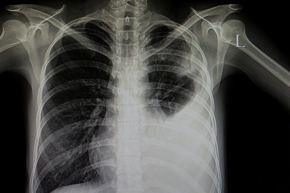 Ist es Corona oder nicht: Studentin entwickelt Röntgen-Software für COVID-19-Diagnose