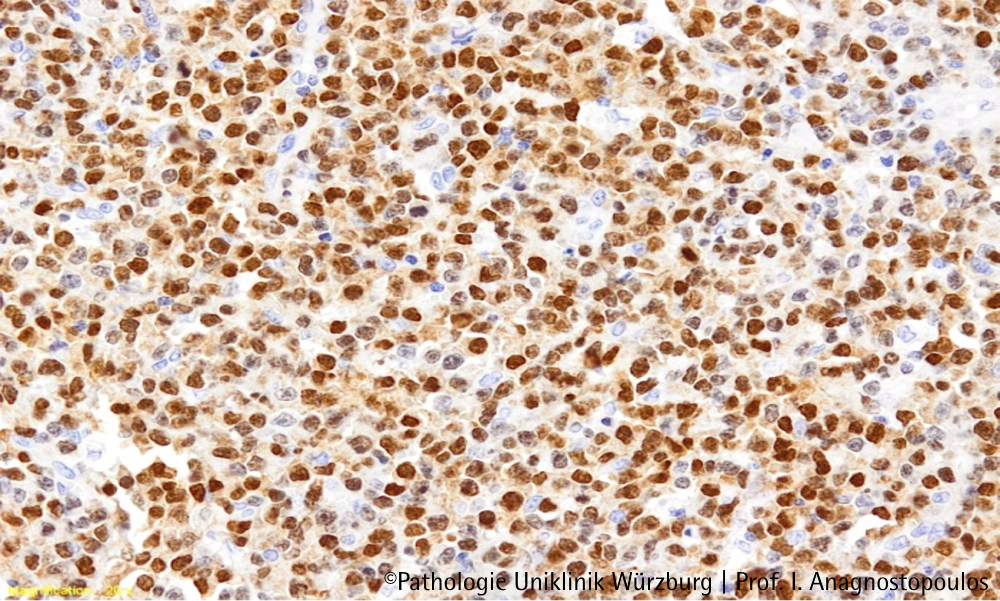 Angeborene Immunschwäche entdeckt – und aufgeklärt